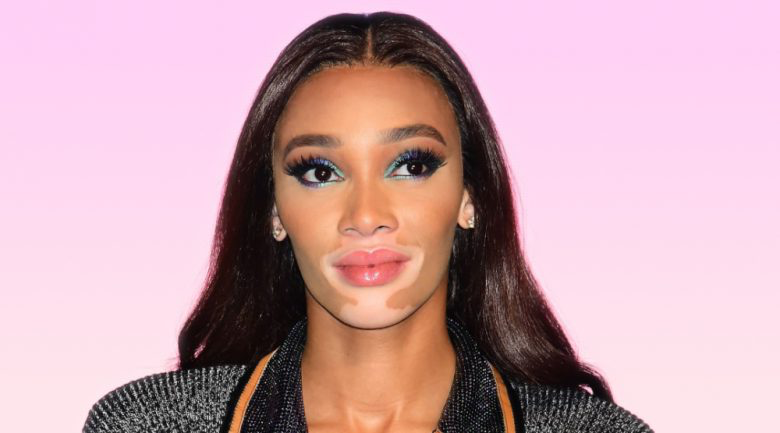 New hope for Vitiligo sufferers