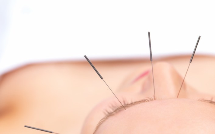 Is aesthetic acupuncture the new Botox?