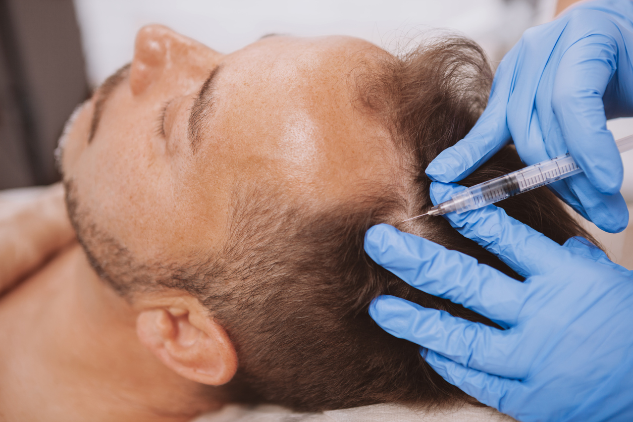 PRP is liquid gold for hair loss