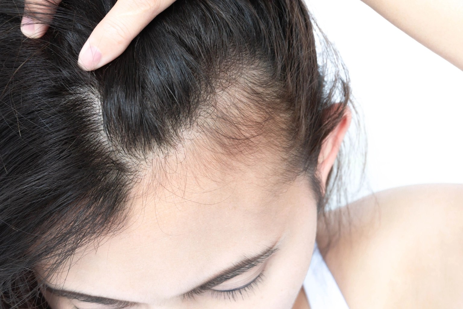 The rise of filler-induced alopecia