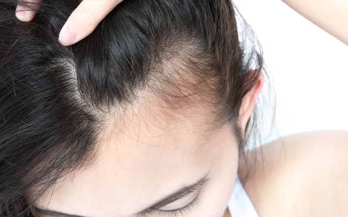 The rise of filler-induced alopecia