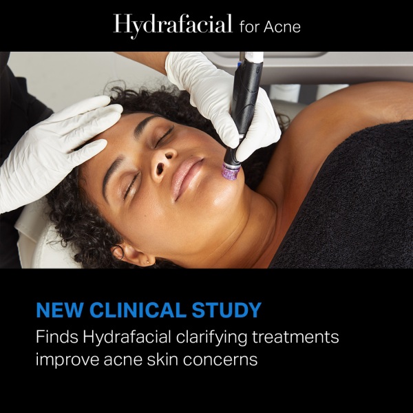 New Study Finds Hydrafacial Improves Acne