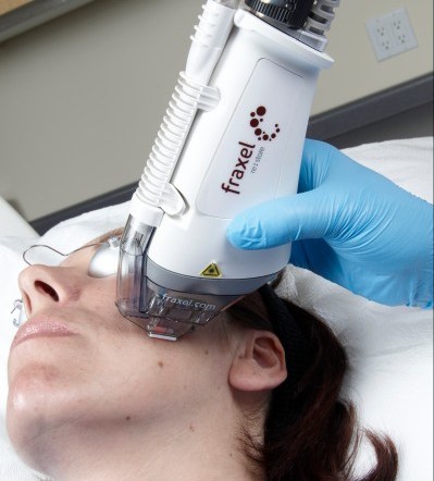 Here’s How Fraxel Laser Technology Can Safely Treat All Skin Types With Maximal Results