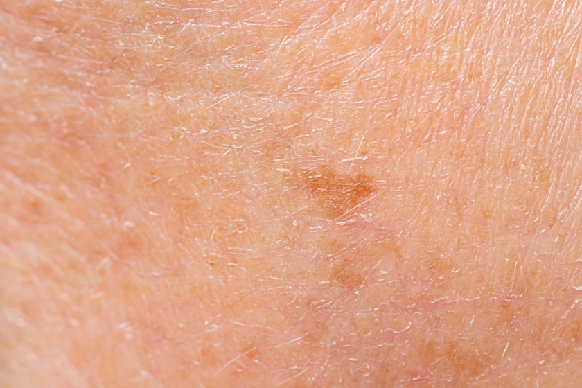 Why This Dermatologist Prefers A 755nm Pico Laser Over 1064nm For Pigmentation