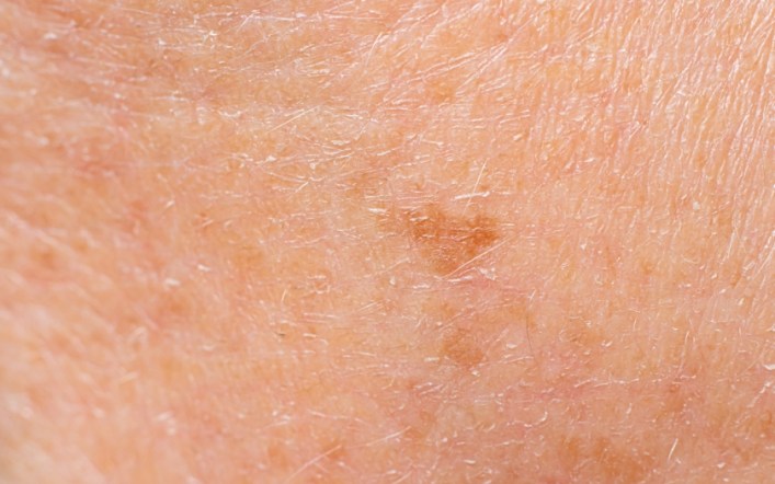 Why This Dermatologist Prefers A 755nm Pico Laser Over 1064nm For Pigmentation