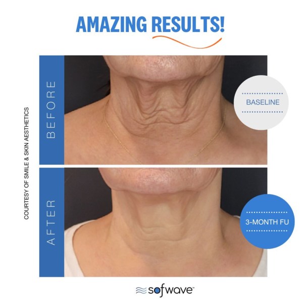 Breakthrough Ultrasound Skin Tightening Technology with Sofwave