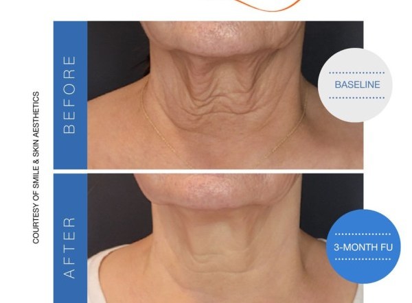 Breakthrough Ultrasound Skin Tightening Technology with Sofwave