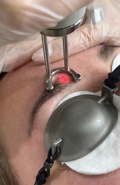 The Rise Of Laser Brow Tattoo Removal