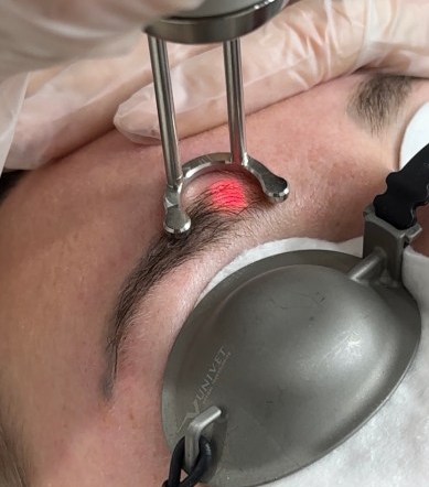 The Rise Of Laser Brow Tattoo Removal