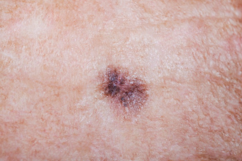 An mRNA Vaccine For Preventing Melanoma Could Be Here In 2025