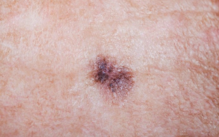 An mRNA Vaccine For Preventing Melanoma Could Be Here In 2025