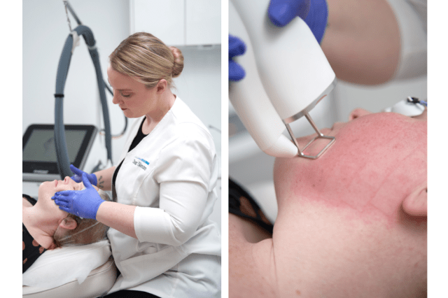Clear Skincare Clinics Welcomes New Non-ablative Laser Device, Renuva