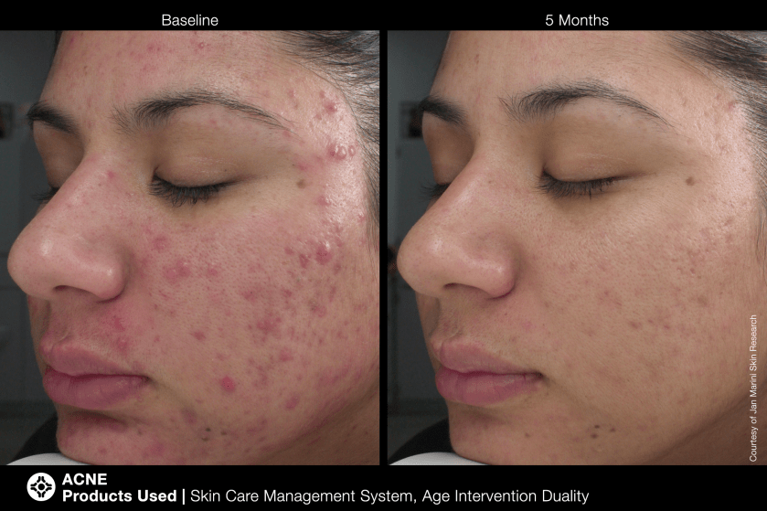 The Science Behind Acne and Suitable Skincare Solutions